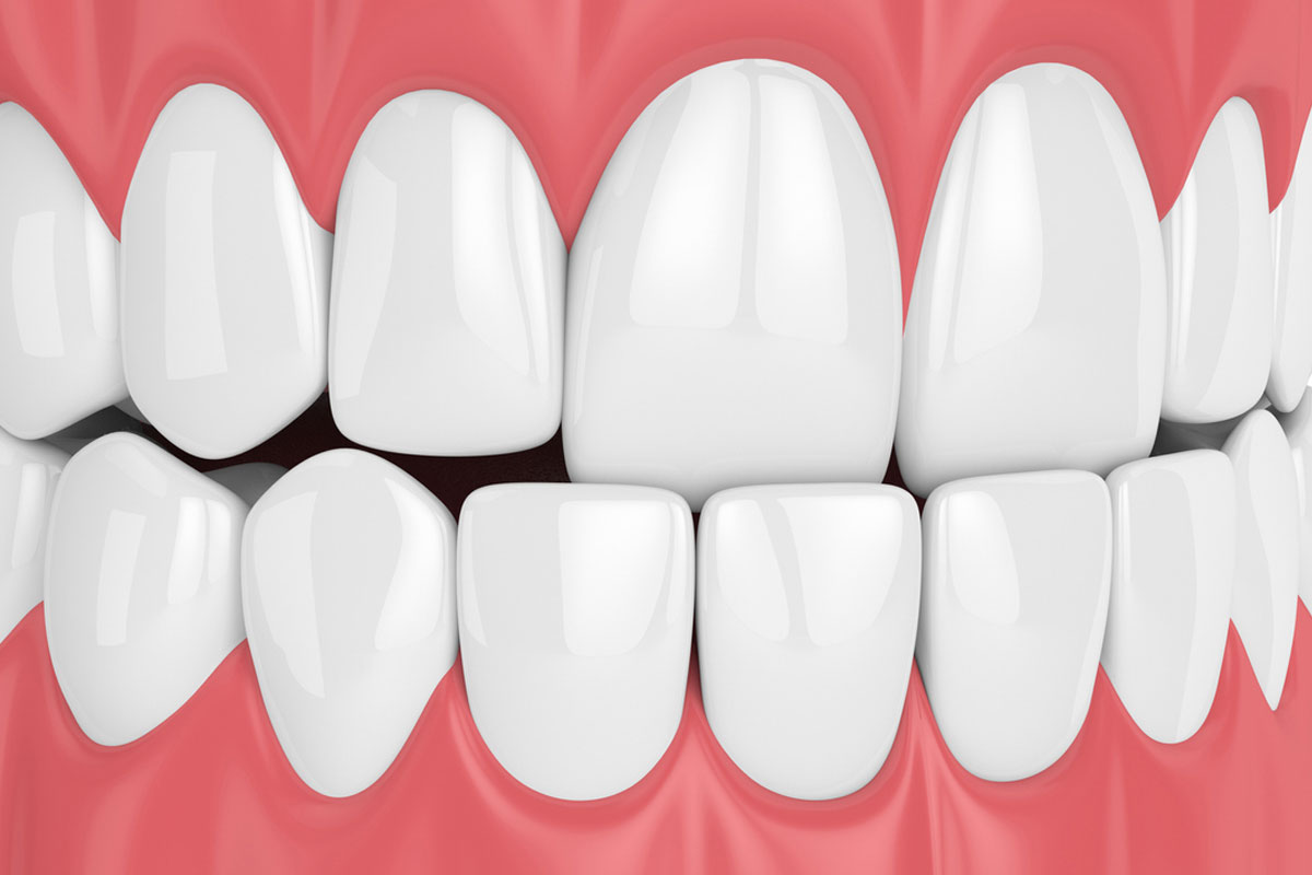 ¿Qué tipos de oclusión dental hay?